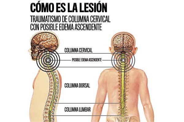 El nintildeo habriacutea sufrido un traumatismo cervical grave pero reversible
