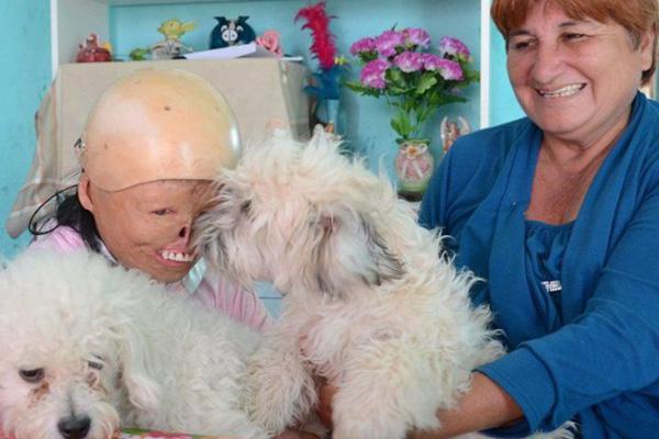 La nintildea que perdioacute el rostro pero no las ganas de vivir