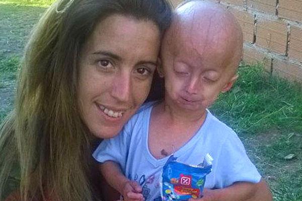 La dramaacutetica historia de Franco un nene con una enfermedad que acelera el envejecimiento