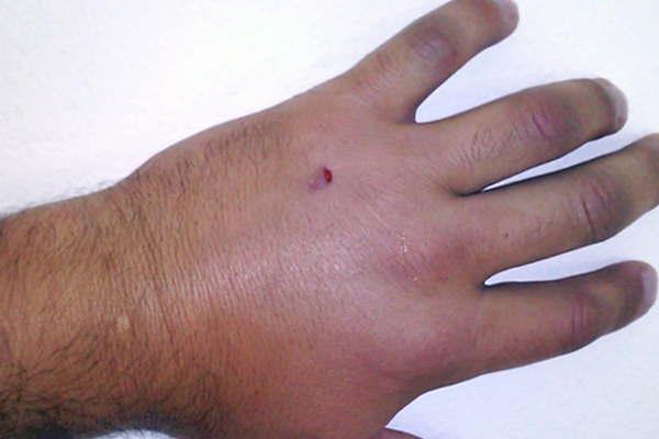 Queacute hacer y coacutemo actuar ante la picadura de los insectos peligrosos para evitar complicaciones