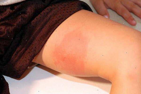 Crecieron las consultas  en los centros de salud por picaduras de insecto
