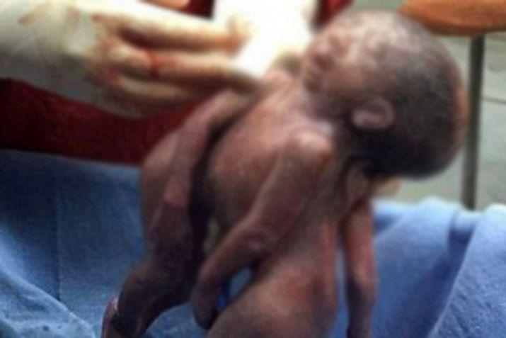 Gran conmocioacuten por bebeacutes siameses con una cabeza