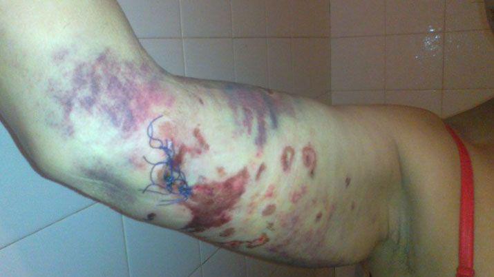 Brutal ataque de tres perros a una mujer- Sufrioacute graves heridas en la cabeza