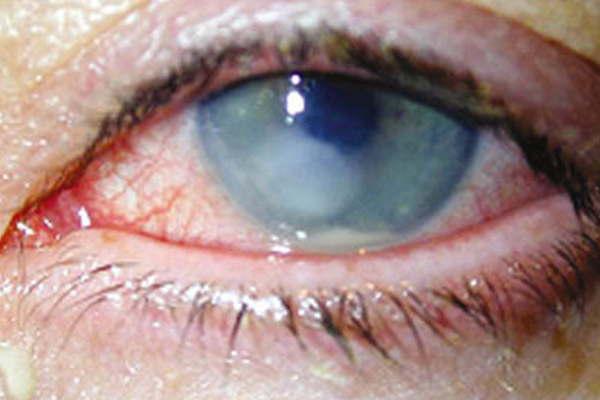 iquestQueacute es una uacutelcera de la coacuternea