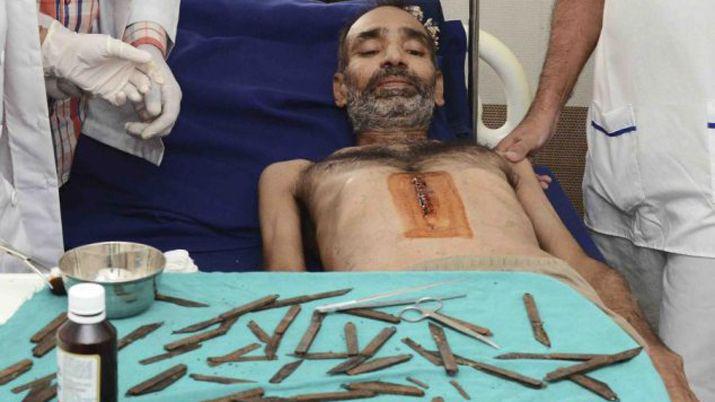 Increiacuteble- extrajeron 40 cuchillos del estoacutemago a un policiacutea en India