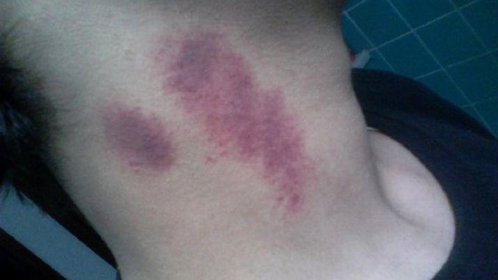 Joven murioacute despueacutes de un chupoacuten de la novia