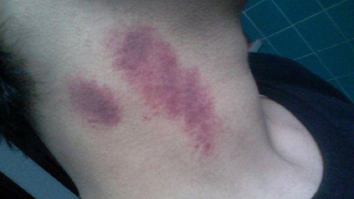 Insoacutelito- un chico murioacute por un chupoacuten de su novia