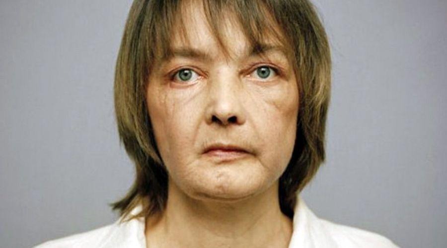 Murioacute la mujer que recibioacute el primer trasplante de cara del mundo