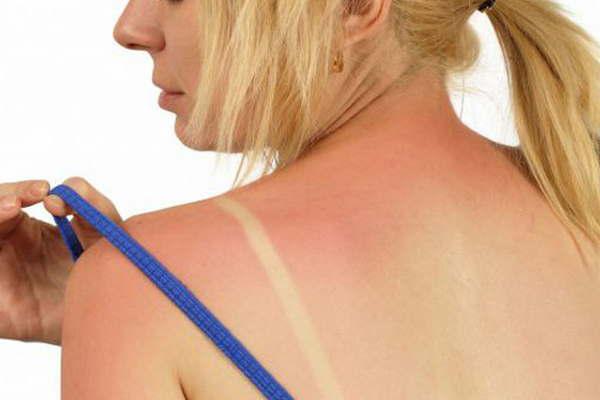 Lesiones en la piel- advierten sobre los riesgos de la exposicioacuten al sol sin la proteccioacuten adecuada