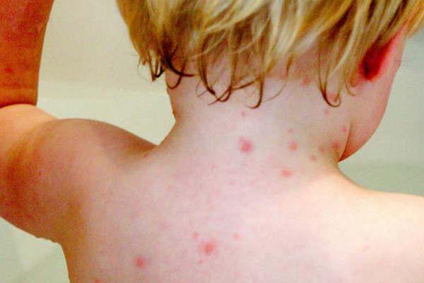 Advierten sobre el incremento de casos de varicela  en la ciudad 
