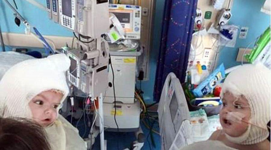 Siameses recieacuten separados logran mirarse cara a cara por primera vez