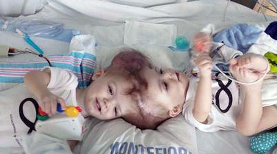 Siameses recieacuten separados logran mirarse cara a cara por primera vez