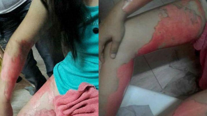 En medio de un ataque de celos un boxeador quemoacute a su pareja