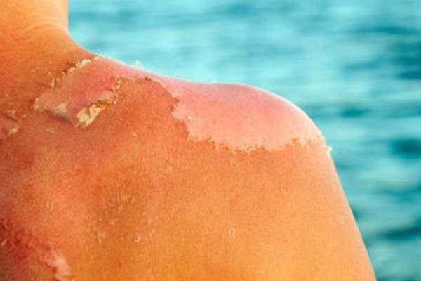 Quemadura de piel- advierten sobre los dantildeos que ocasiona  la mala exposicioacuten al sol