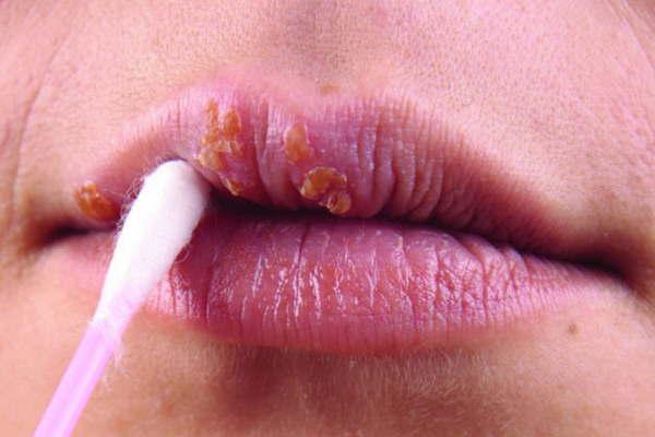 Coacutemo se presentan las lesiones que provoca el virus del papiloma humano