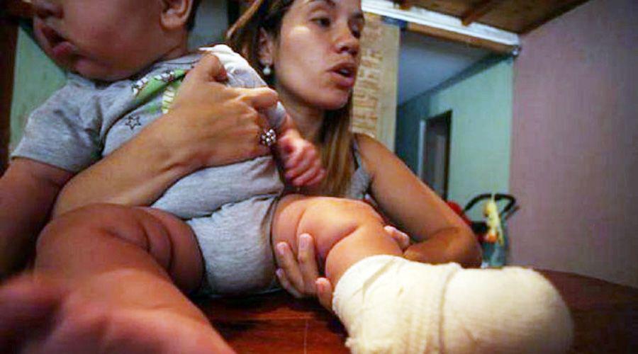 Celular explotoacute y le quemoacute el pie a bebeacute de 6 meses