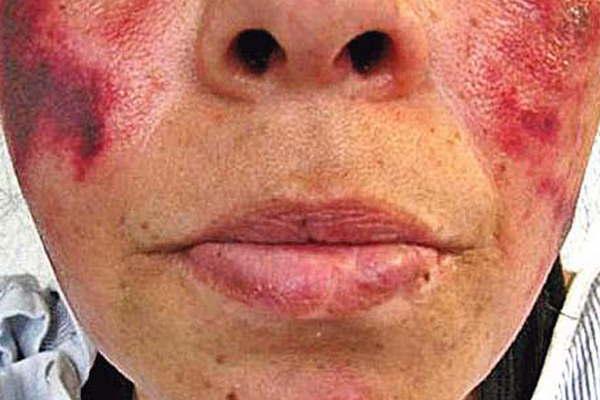 Una sustancia de corte les pudre la carne a los adictos y estaacute en Argentina