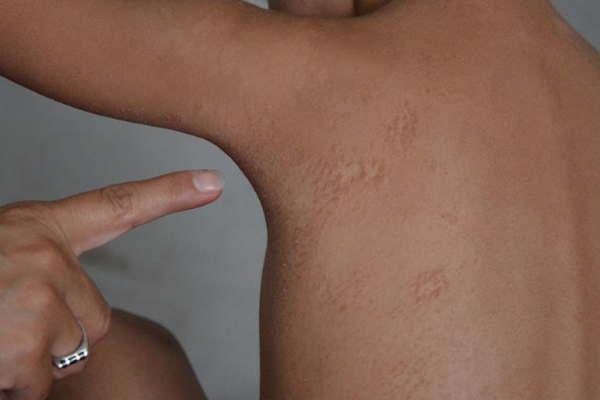 Cuaacuteles son las diez alergias de verano que pueden arruinar tu descanso si no sabes prevenirlas