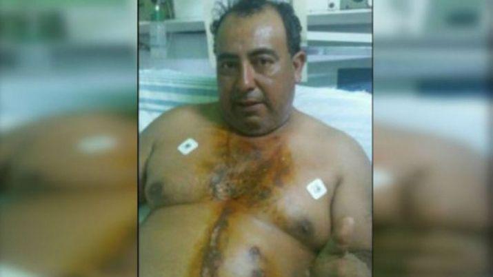 Santa Fe- lo alcanzoacute un rayo y se salvoacute de milagro