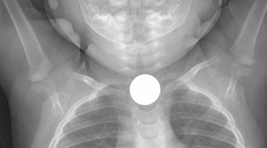 Tragoacute una moneda de un peso y estaacute internada en el Cepsi