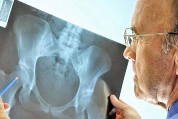 Realizaraacuten controles gratis para detectar osteoporosis precoz