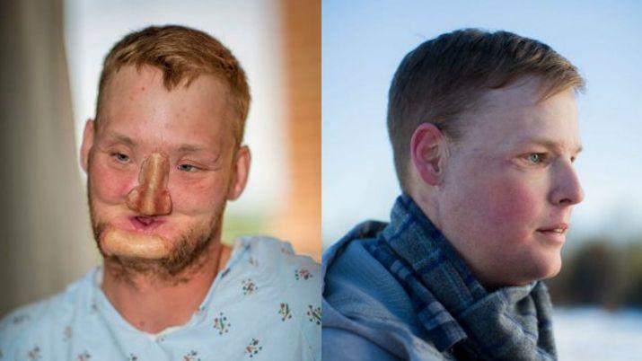 Se voloacute la cara y le implantaron la de otro suicida