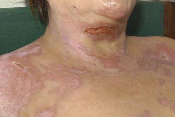 El testimonio de una mujer rociada con alcohol y prendida fuego por su ex