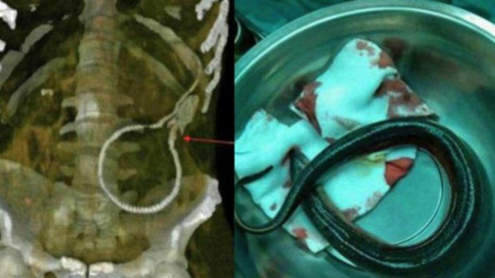 Se introdujo una anguila para curar su estrentildeimiento y casi se muere