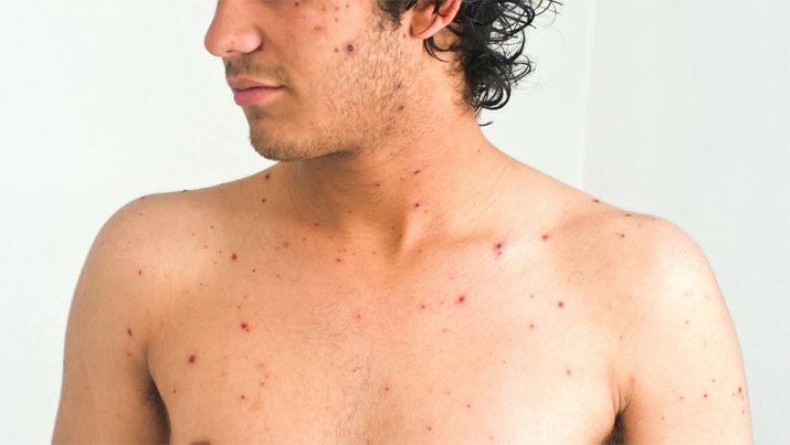 Tucumaacuten- Se confirmoacute un caso importado de Sarampioacuten