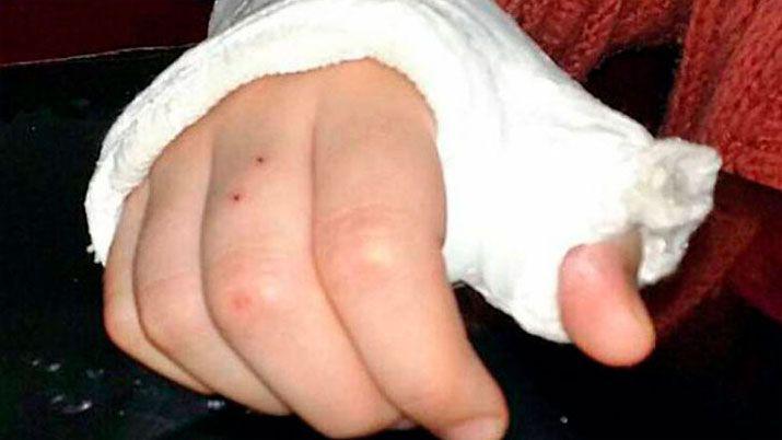 Bullying extremo- le rompieron una mano y le arrancaron los pelos