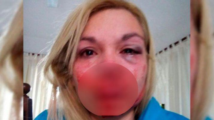 Discutioacute con su pareja y la desfiguroacute