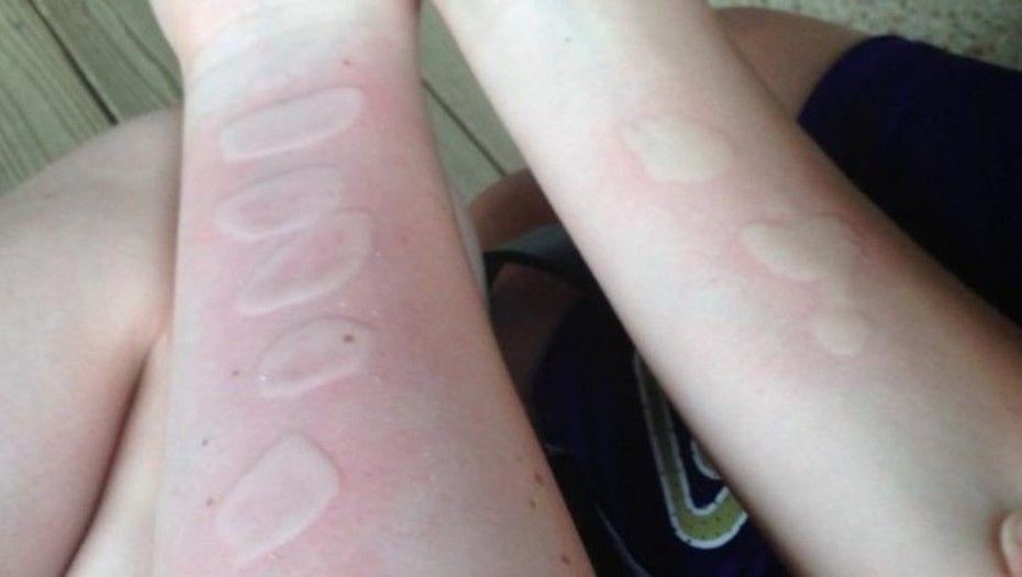 Quemarse con hielo y sal el peligroso reto viral de internet