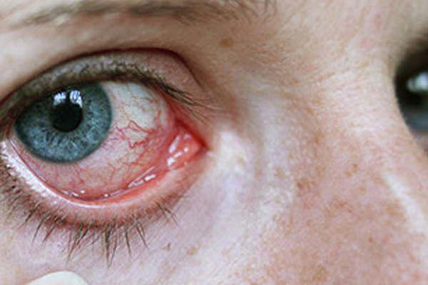 iquestQueacute son las alergias de los ojos (1ordf parte)