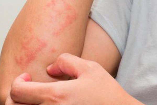 Aseguran que factores como la obesidad el alcohol y el tabaco puede ser causantes de la psoriasis