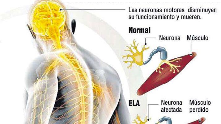 ELA- una enfermedad neurodegenerativa sin cura  (esclerosis lateral amiotroacutefica)