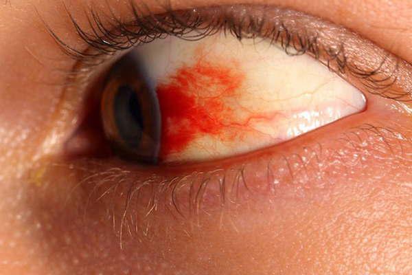 La retinopatiacutea diabeacutetica (1ordf parte)