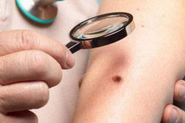 Con la llegada del verano advierten por los factores de riesgo del melanoma