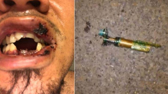 Le explotoacute su cigarrillo electroacutenico y perdioacute 4 dientes
