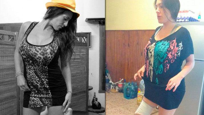 Fue por una liposuccioacuten y le amputaron una pierna