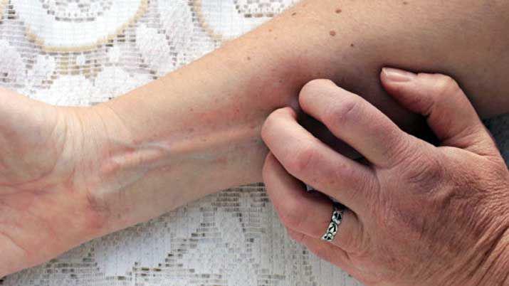 Alergias de verano- cuaacuteles son los principales desencadenantes de estas molestas reacciones