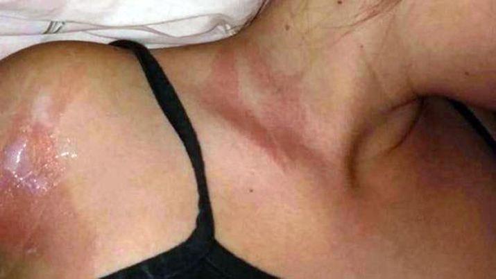 Se rompioacute la funda de su celular y sufrioacute quemaduras de primer grado