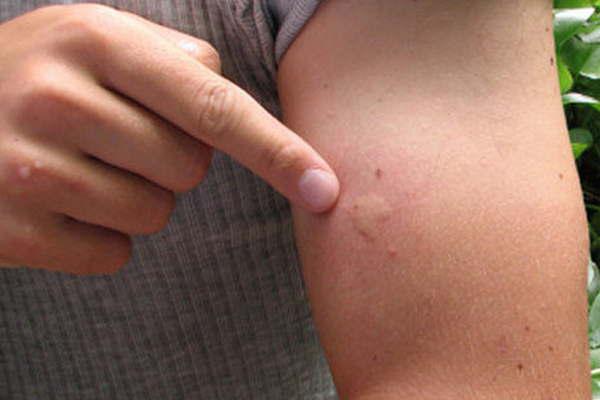 Queacute hacer ante la picadura  de un animal venenoso