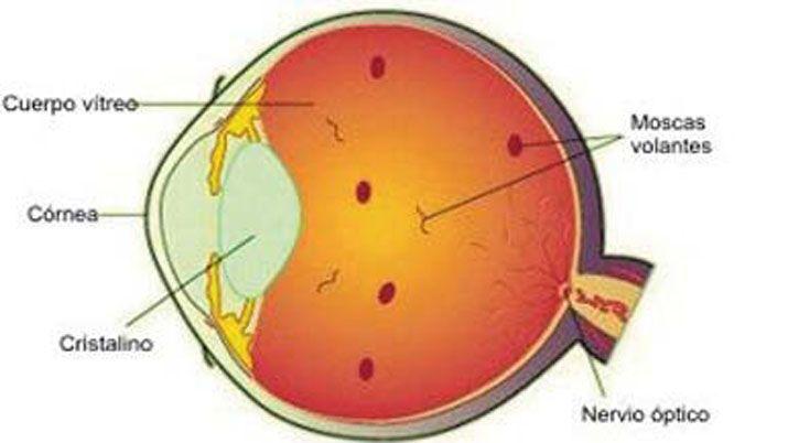 iquestQueacute son las moscas volantes y los centelleos