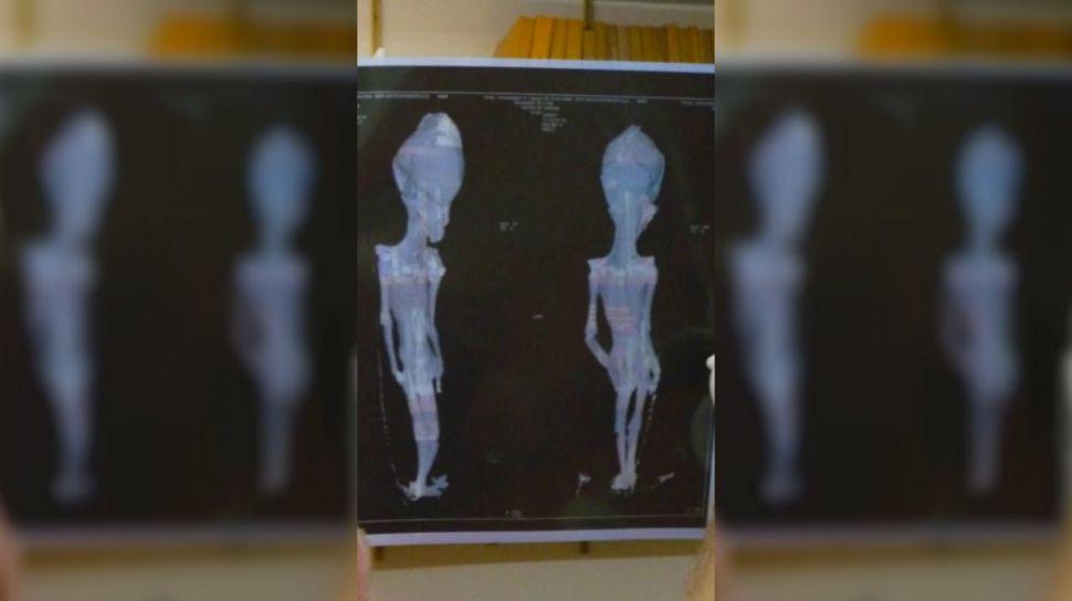 Chile- resolvieron el misterio de la momia alien de Atacama tras 15 antildeos