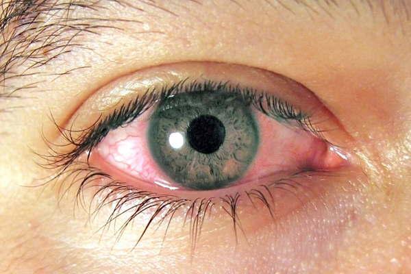 iquestQueacute es una uacutelcera de coacuternea 1ordf parte