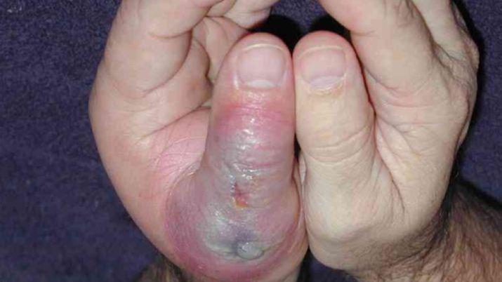 iquestCuaacuteles son los siacutentomas que ocasiona una picadura