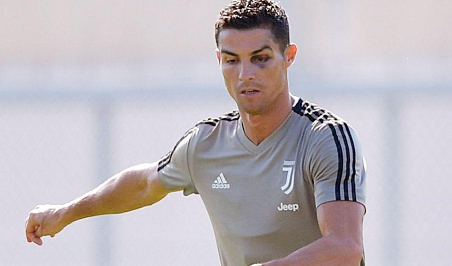 Video El ojo morado de Cristiano Ronaldo