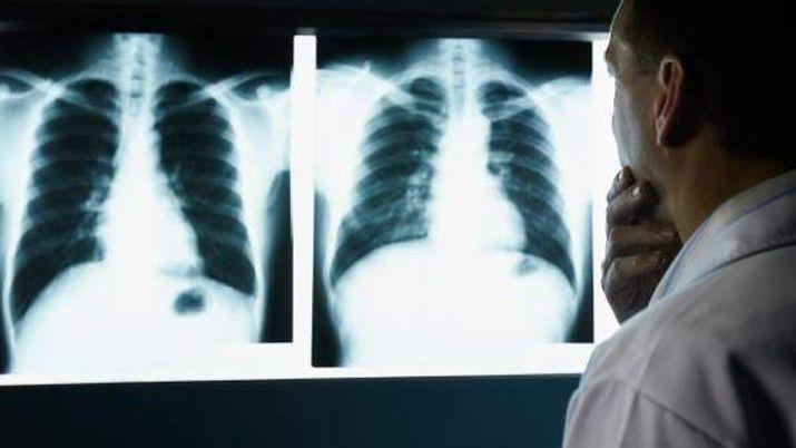 Seguacuten la OMS uno de cada cinco argentinos tendraacute caacutencer