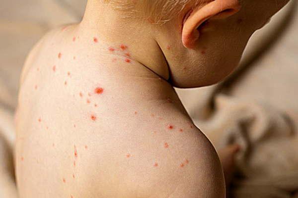 Cuaacuteles son las enfermedades de las que previene la vacuna y sus principales caracteriacutesticas