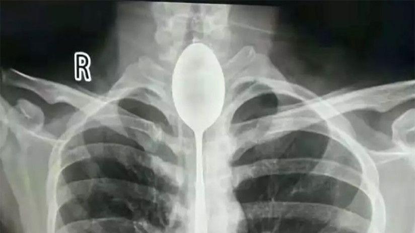 Insoacutelito- Vivioacute un antildeo con una cuchara de 20 centiacutemetro en su esofago